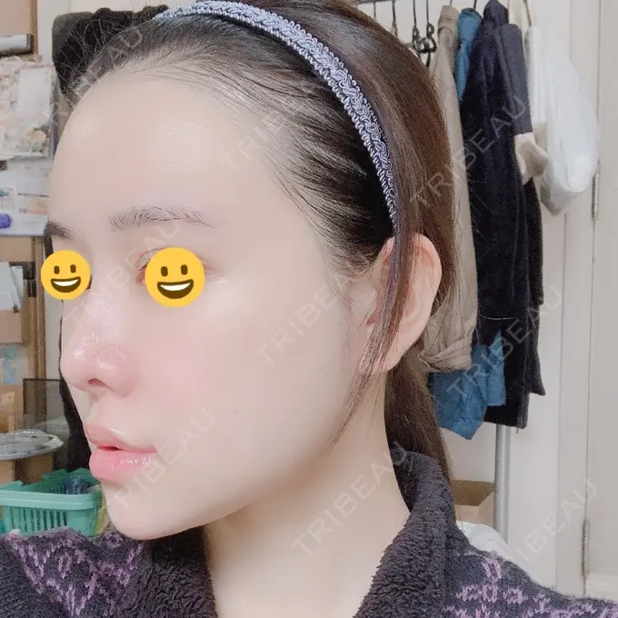 脂肪注入（肌） / 脂肪注入（額） / 脂肪注入（輪郭） スノウ（Snow）整形外科 DAY 16 メイン用