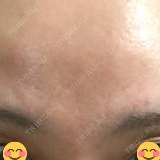 ボトックス（目尻） / ボトックス（額） TCB東京中央美容外科 福岡天神院 AFTER メイン用