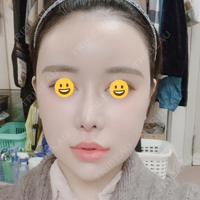 脂肪注入（肌） / 脂肪注入（額） / 脂肪注入（輪郭） スノウ（Snow）整形外科 DAY 17 メイン用