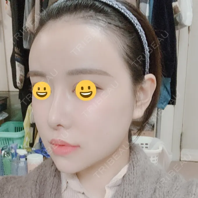 脂肪注入（肌） / 脂肪注入（額） / 脂肪注入（輪郭） スノウ（Snow）整形外科 DAY 17 メイン用