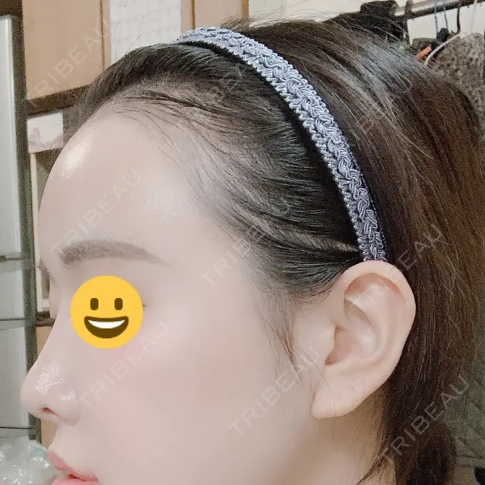 脂肪注入（肌） / 脂肪注入（額） / 脂肪注入（輪郭） スノウ（Snow）整形外科 DAY 17 メイン用