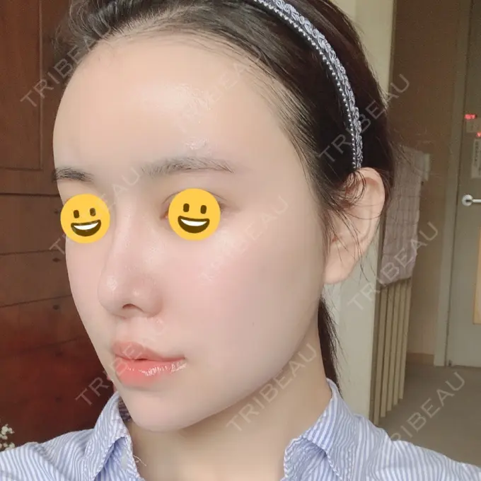 脂肪注入（肌） / 脂肪注入（額） / 脂肪注入（輪郭） スノウ（Snow）整形外科 DAY 21 メイン用