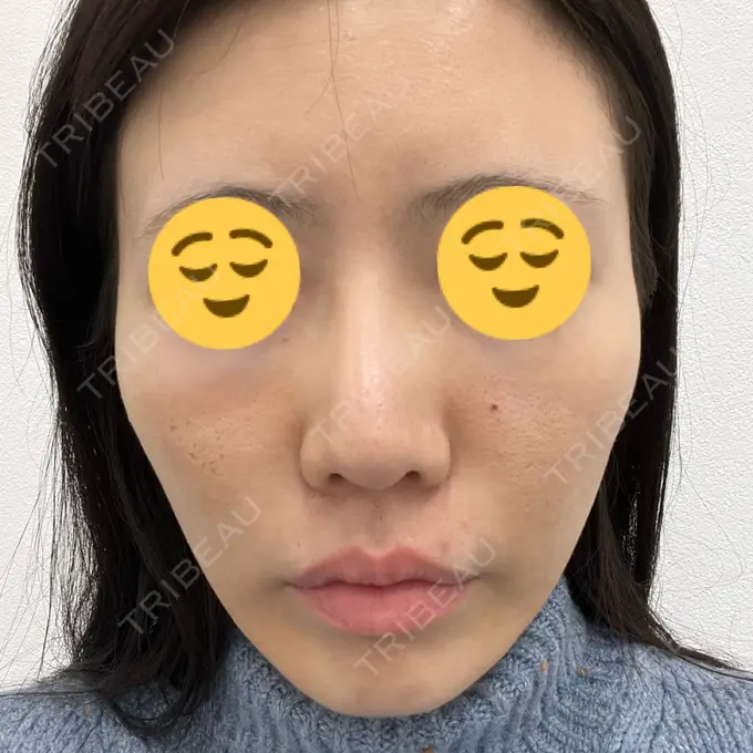 ハイフ（顔） TCB東京中央美容外科 静岡院 AFTER メイン用