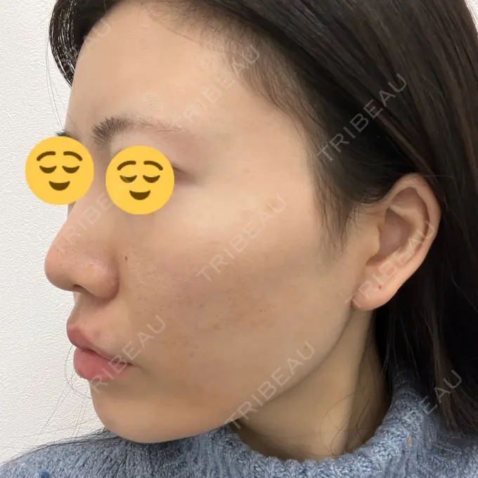 ハイフ（顔） TCB東京中央美容外科 静岡院 DAY 0 メイン用