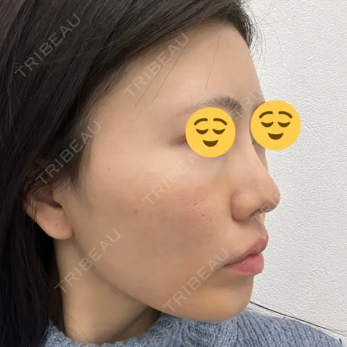 ハイフ（顔） TCB東京中央美容外科 静岡院 DAY 0 メイン用