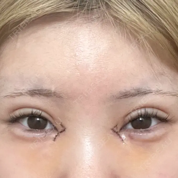 二重埋没 / 目頭切開 / 自然癒着法 AI Beauty Clinic （エーアイ美容クリニック） DAY 6 メイン用