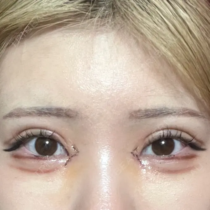 二重埋没 / 目頭切開 / 自然癒着法 AI Beauty Clinic （エーアイ美容クリニック） DAY 6 メイン用