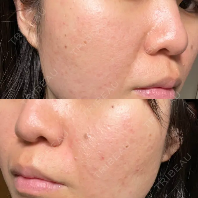 ピーリング（ニキビ・毛穴） / ポテンツァ A CLINIC（エークリニック） 仙台院 DAY 5 メイン用