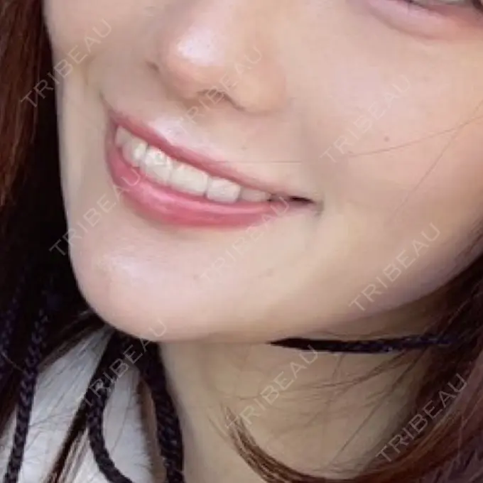 ヒアルロン酸注入（唇） / ボトックス（口角） フィラークリニック 渋谷院 DAY 0 メイン用