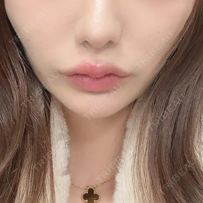 ヒアルロン酸注入（唇） / ボトックス（口角） フィラークリニック 渋谷院 DAY 1 メイン用