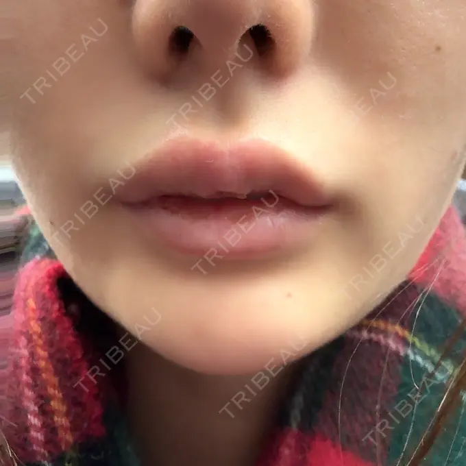 ヒアルロン酸注入（唇） / ボトックス（口角） フィラークリニック 渋谷院 AFTER メイン用