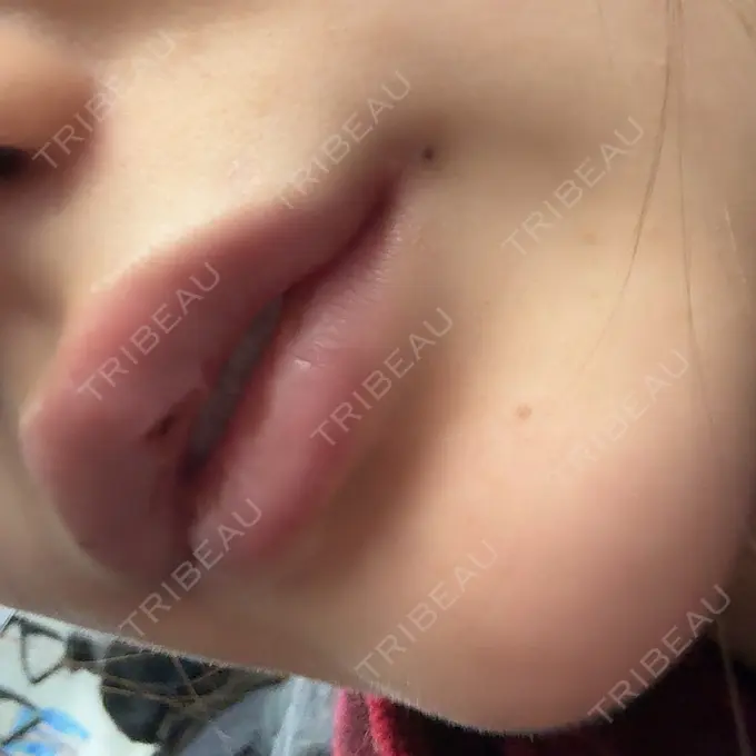 ヒアルロン酸注入（唇） / ボトックス（口角） フィラークリニック 渋谷院 DAY 2 メイン用