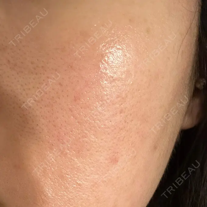 ピーリング（ニキビ・毛穴） / ニキビ治療 Mavie Beauty Clinic （マヴィービューティークリニック） AFTER メイン用