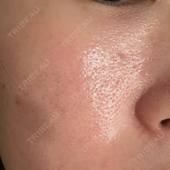 ピーリング（ニキビ・毛穴） / ニキビ治療 Mavie Beauty Clinic （マヴィービューティークリニック） DAY 5 メイン用