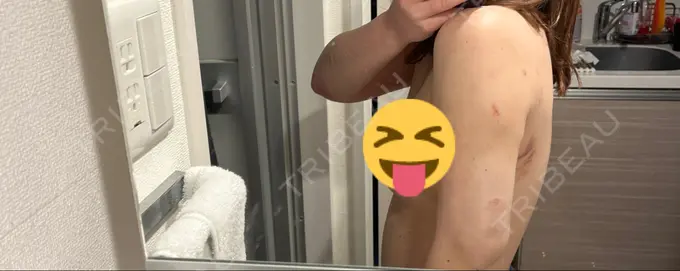 インディバ（二の腕） WOM SALON【術後ケア取扱いサロン】 AFTER メイン用