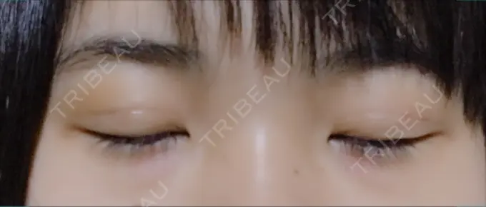 二重埋没 久留米総合美容外科 AFTER メイン用