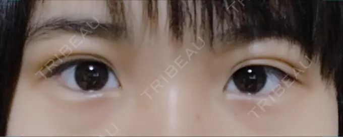 二重埋没 久留米総合美容外科 DAY 6 メイン用