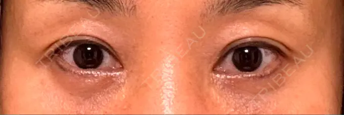 目尻切開 / タレ目形成・グラマラスライン（埋没） / 美容点滴・美容注射（美肌） LOUIS CLINIC 二子玉川院【ルイクリニック】 AFTER メイン用