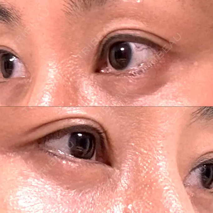 目尻切開 / タレ目形成・グラマラスライン（埋没） / 美容点滴・美容注射（美肌） LOUIS CLINIC 二子玉川院【ルイクリニック】 DAY 31 メイン用