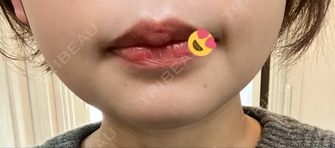 ハイフ（顔） 湘南美容クリニック 仙台院 DAY 20 メイン用