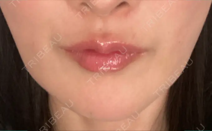 糸リフト / 脂肪吸引（顔） RIVER CLINIC（リバークリニック） DAY 40 メイン用