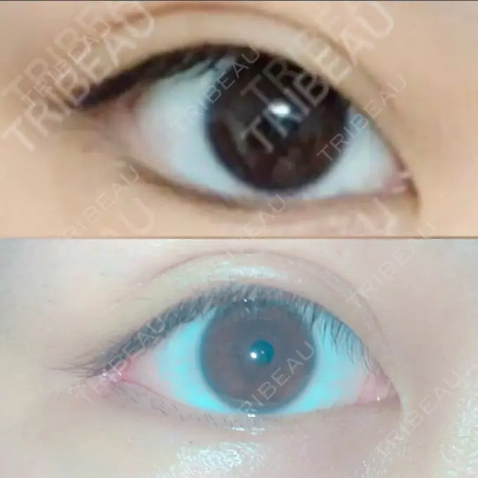 目尻切開 / タレ目形成・グラマラスライン（切開） / 目尻靭帯移動 FROM B整形外科 (旧バウム整形外科) AFTER メイン用