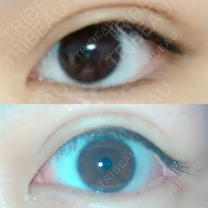 目尻切開 / タレ目形成・グラマラスライン（切開） / 目尻靭帯移動 FROM B整形外科 (旧バウム整形外科) DAY 58 メイン用