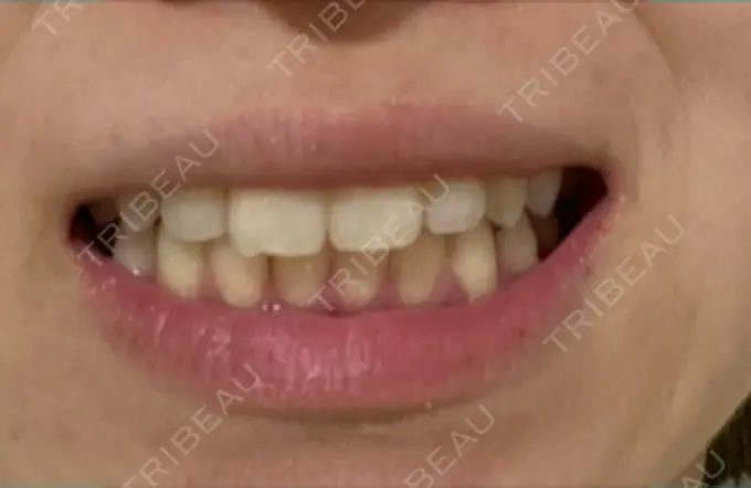 ホワイトニング オーラルビューティークリニック クラリス審美歯科・矯正歯科 DAY 17 メイン用