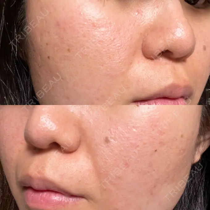 ピーリング（ニキビ・毛穴） / ポテンツァ A CLINIC（エークリニック） 仙台院 DAY 7 メイン用