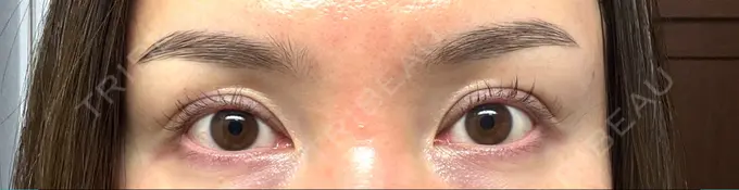 二重埋没 東京シンデレラ美容外科 大宮院 DAY 7 メイン用