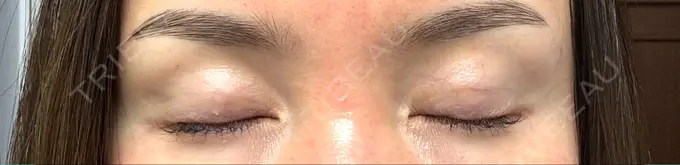 二重埋没 東京シンデレラ美容外科 大宮院 DAY 7 メイン用