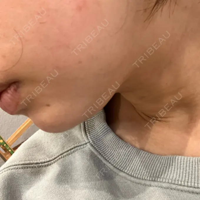 ハイフ（顔） 湘南美容クリニック 仙台院 DAY 22 メイン用