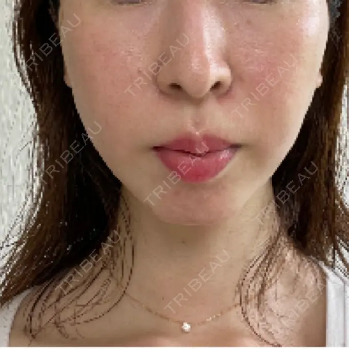 光治療（フォトフェイシャルなど） ゆめビューティークリニック AFTER メイン用