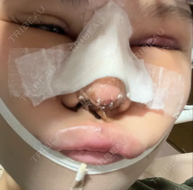 鼻尖形成（切開） / 糸リフト / 脂肪吸引（顔） / ジョールファット除去 / ヒアルロン酸注入（あご） / ヒアルロン酸注入（唇） / ボトックス（口角） / ヒアルロン酸注入（額） / ヒアルロン酸注入（鼻翼基部） 東京シンデレラ美容外科 池袋院 DAY 0 メイン用