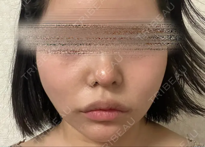 鼻尖形成（切開） / 糸リフト / 脂肪吸引（顔） / ジョールファット除去 / ヒアルロン酸注入（あご） / ヒアルロン酸注入（唇） / ボトックス（口角） / ヒアルロン酸注入（額） / ヒアルロン酸注入（鼻翼基部） 東京シンデレラ美容外科 池袋院 AFTER メイン用