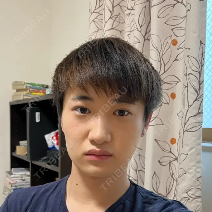 糸リフト / あごプロテーゼ 湘南美容クリニック 上野院 DAY 566 メイン用