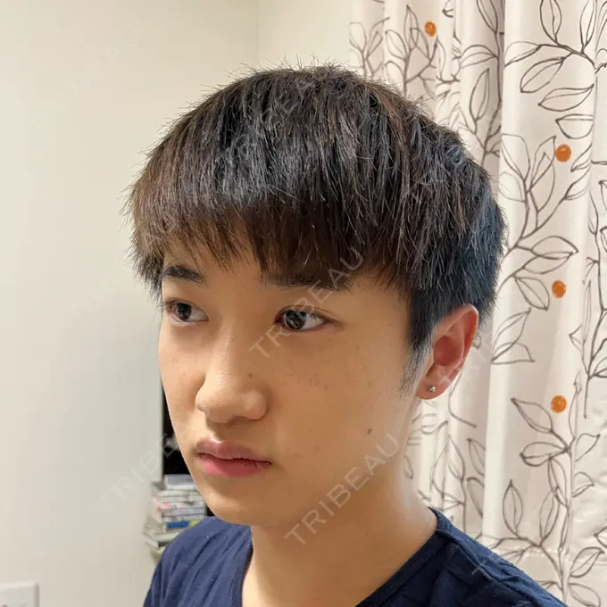 糸リフト / あごプロテーゼ 湘南美容クリニック 上野院 AFTER メイン用