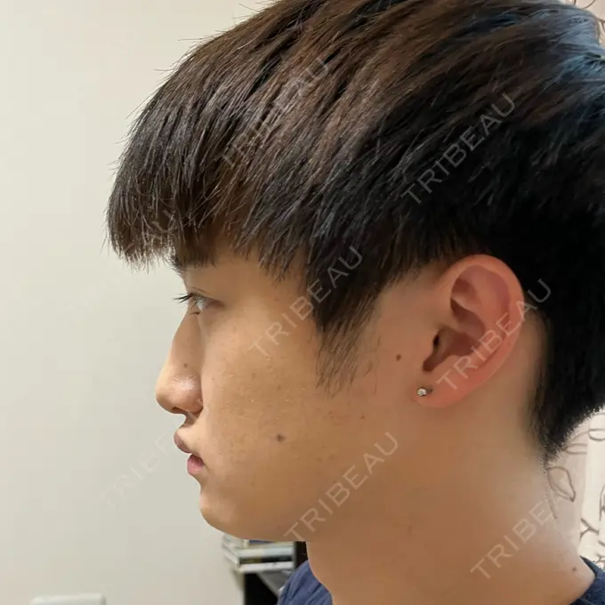 糸リフト / あごプロテーゼ 湘南美容クリニック 上野院 DAY 566 メイン用