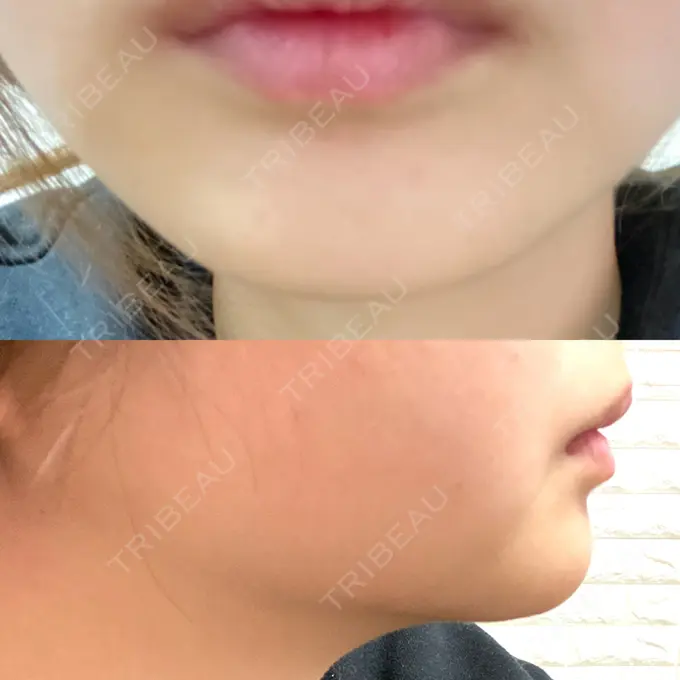 ボトックス（あご） / ボトックス（エラ・小顔） / ボトックス（眉間） M'sクリニック【エムズクリニック】 AFTER メイン用