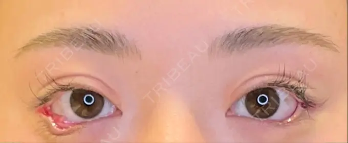 目尻切開 / タレ目形成・グラマラスライン（埋没） LOUIS CLINIC 二子玉川院【ルイクリニック】 DAY 0 メイン用