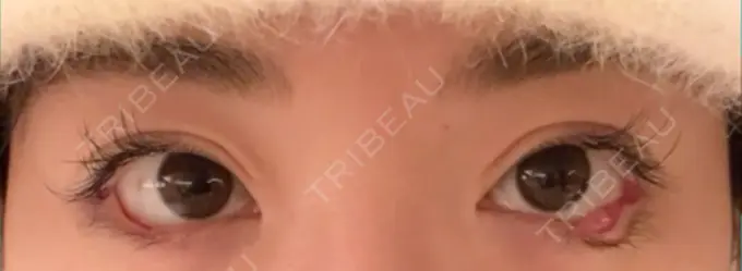 目尻切開 / タレ目形成・グラマラスライン（埋没） LOUIS CLINIC 二子玉川院【ルイクリニック】 DAY 0 メイン用