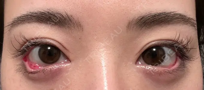 目尻切開 / タレ目形成・グラマラスライン（埋没） LOUIS CLINIC 二子玉川院【ルイクリニック】 DAY 0 メイン用