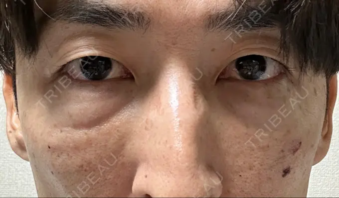 下まぶたたるみ取り / 脂肪注入（目の下） 湘南美容クリニック 池袋東口院 DAY 0 メイン用