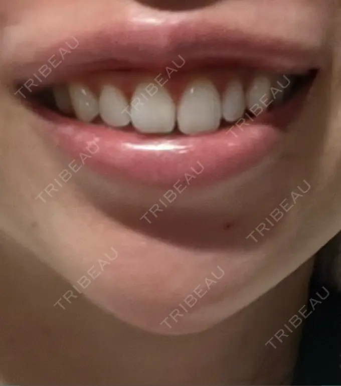 ボトックス（ガミースマイル） 椿クリニック 心斎橋院 DAY 2 メイン用