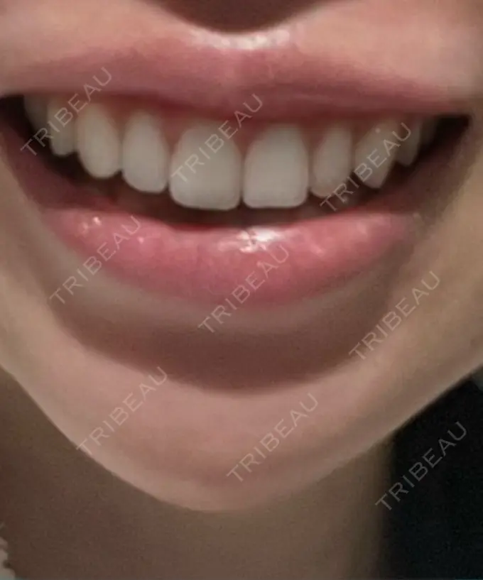 ボトックス（ガミースマイル） 椿クリニック 心斎橋院 DAY 4 メイン用