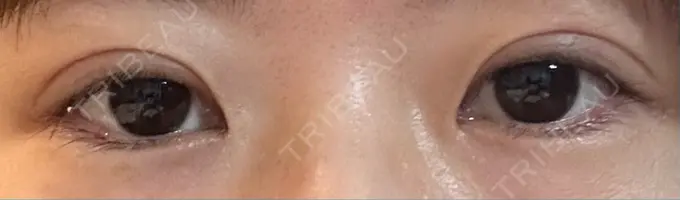 二重埋没 銀座S美容・形成外科クリニック DAY 52 メイン用