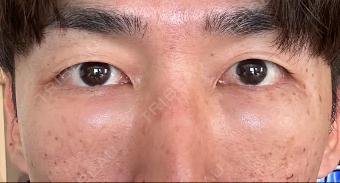 下まぶたたるみ取り / 脂肪注入（目の下） 湘南美容クリニック 池袋東口院 DAY 1 メイン用