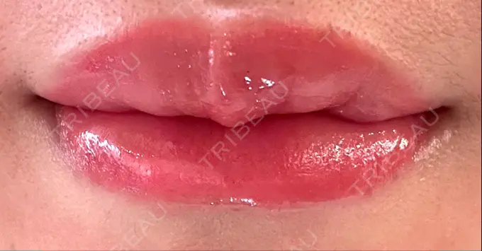 アートメイク（唇） Tokyo Tensei Clinic 新宿院 DAY 88 メイン用