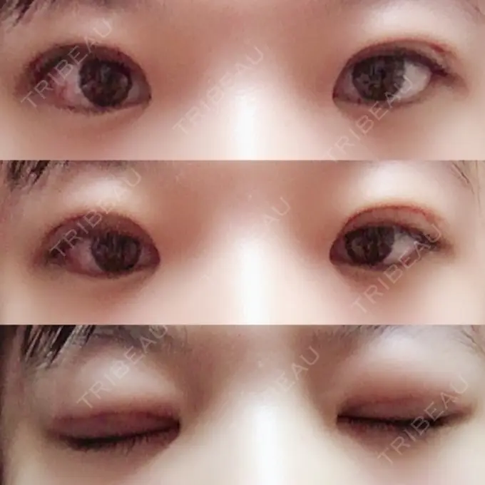 二重切開 / 上まぶたの脂肪取り 聖心美容クリニック 横浜院 DAY 10 メイン用