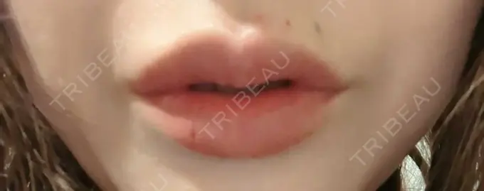 ヒアルロン酸注入（唇） / ボトックス（人中） id美容クリニック 銀座院 DAY 0 メイン用